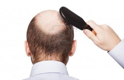 7類脫髮誘因男人治療要分清